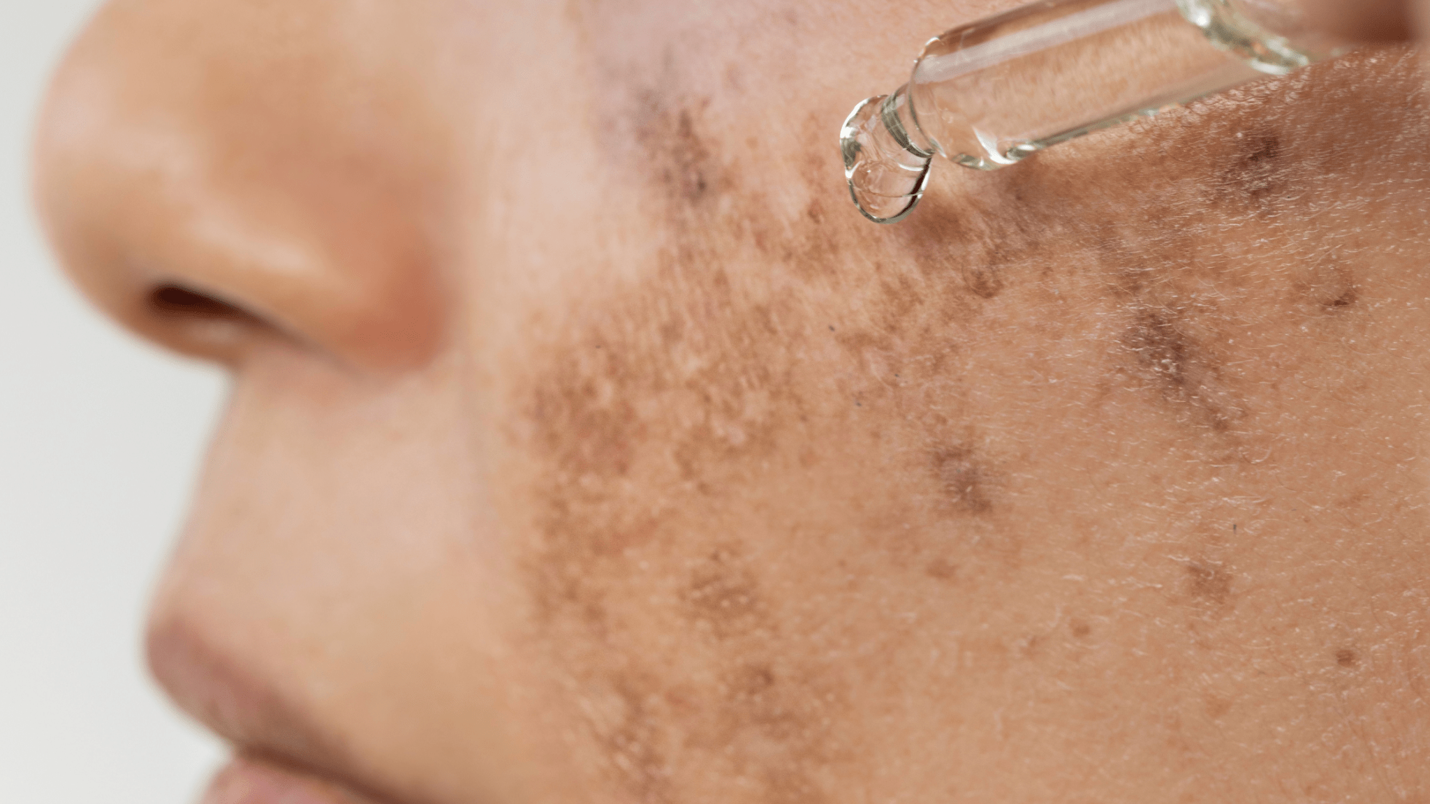 How to Fade Hyperpigmentation Without Damaging Your Skin Barrier - Shéeba London