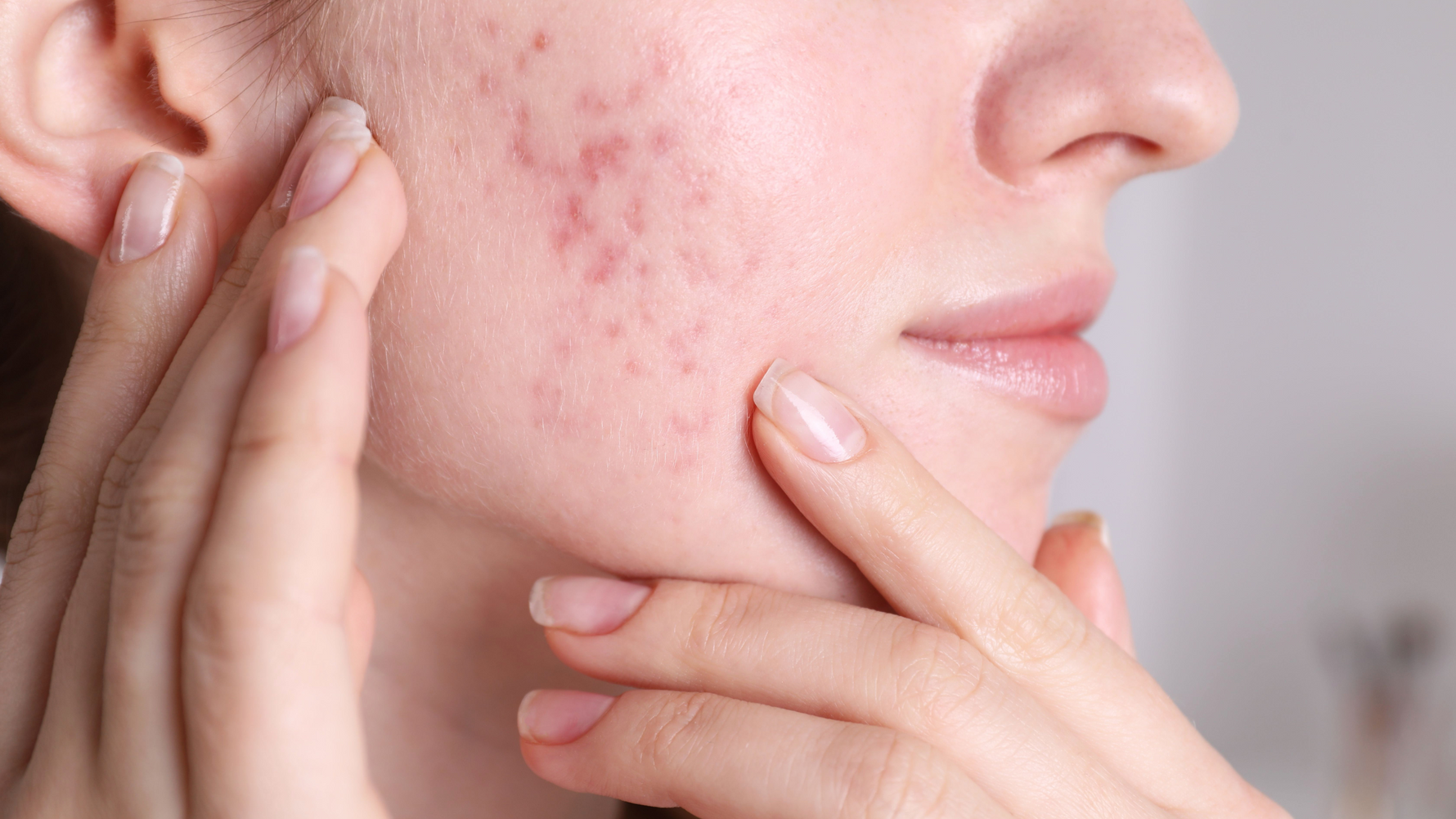 How to Fade Acne Scars & Melasma with Fruit Enzymes and Natural Actives