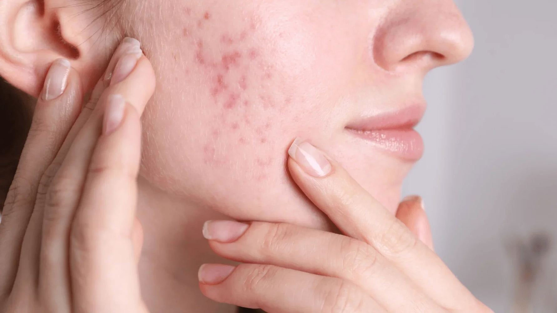 How to Fade Acne Scars & Melasma with Fruit Enzymes and Natural Actives - Shéeba London